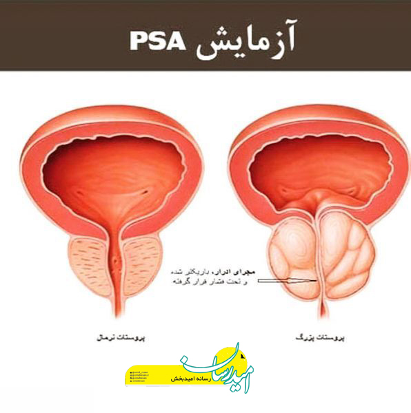 اندازه پروستات در 60 سالگی