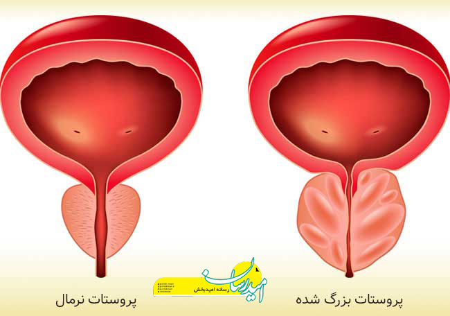اندازه طبیعی پروستات در 60 سالگی