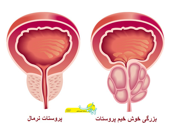 اندازه طبیعی پروستات در 60 سالگی