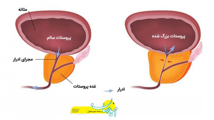 اندازه پروستات در 60 سالگی