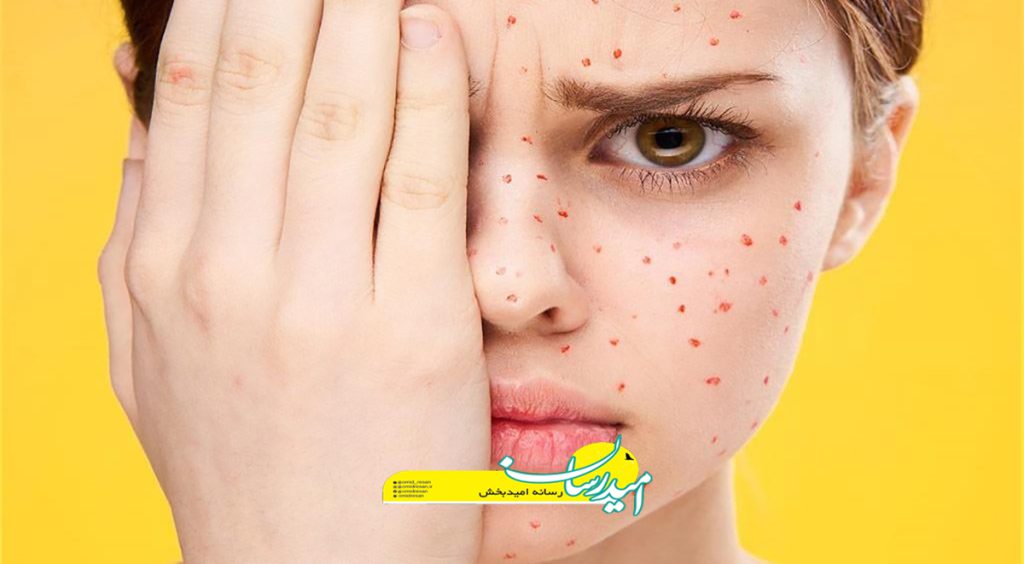 پماد کالامین برای چیست؟ نحوه مصرف و عوارض استفاده از آن