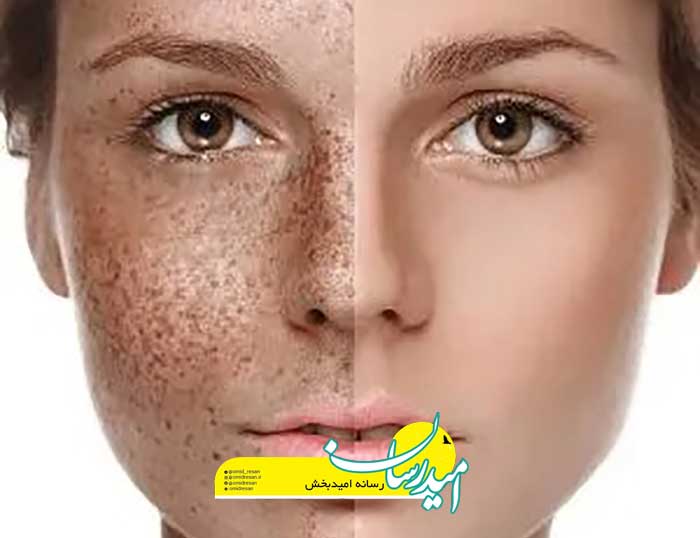 پماد کالامین برای چیست؟ نحوه مصرف و عوارض استفاده از آن