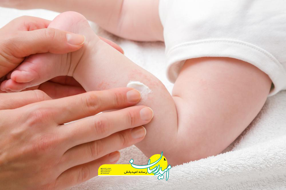 پماد کالامین برای چیست؟ نحوه مصرف و عوارض استفاده از آن