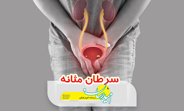 چه غذاهایی برای سرطان مثانه خوب است