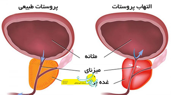 خوراکی های مناسب برای کاهش التهاب پروستات