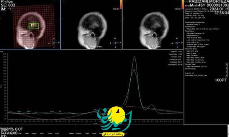 خبر خوب اجتماعی: راه اندازی MRI پیشرفته بررسی ضایعات مغزی در مرکز آموزشی و درمانی پورسینا