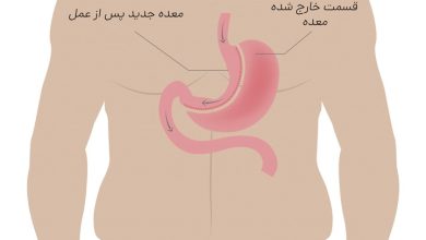 هزینه عمل اسلیو معده در تهران