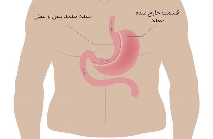 هزینه عمل اسلیو معده در تهران