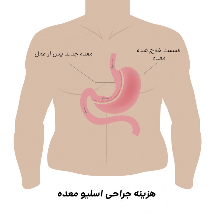هزینه عمل اسلیو معده در تهران