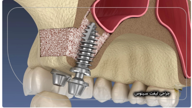همه‌چیز درباره جراحی‌های دندانپزشکی: از لیفت سینوس تا مراقبت‌های ضروری پس از کشیدن دندان