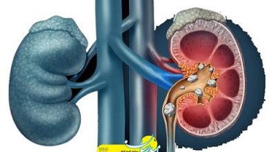برای دفع سنگ کلیه چی بخوریم